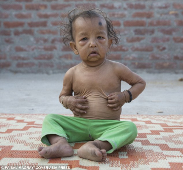 印度两儿童患罕见早衰症 外表似老人(图)