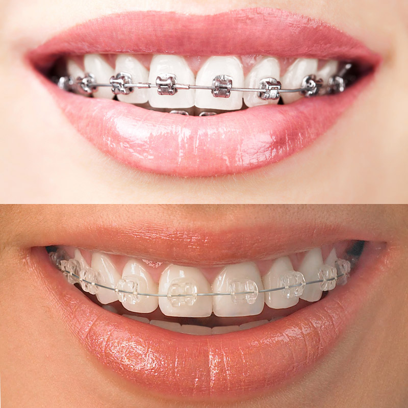 金属托槽牙套(上)和陶瓷托槽牙套(下)