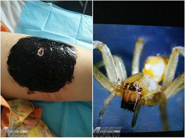13日下午,游仙区云凤镇的李大姐因被蜘蛛叮咬患"急性肾功能衰竭"住院.